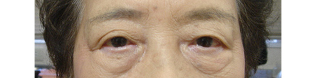 左眼瞼皮膚弛緩症手術後