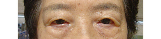 左眼瞼皮膚弛緩症手術前